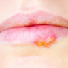 Herpotherm – Lippenherpes effektiv lindern mit Wärmegerät