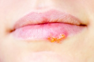 Lippenherpes