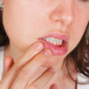 Herpes in 24 Stunden weg » Bläschen loswerden! herpotherm, Hausmittel sowie Lippenherpes abdecken, überschminken & beste Lippenherpescreme