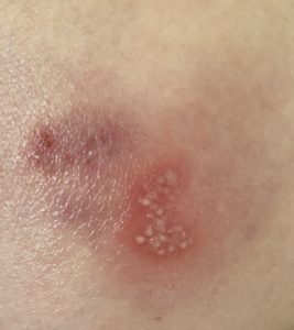 Herpes mit Teebaumöl behandeln